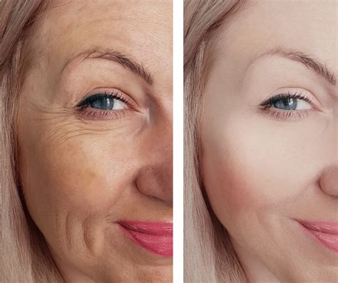 Botox And Juvederm Fillers Skintastics Green Valley Az — Skintastics