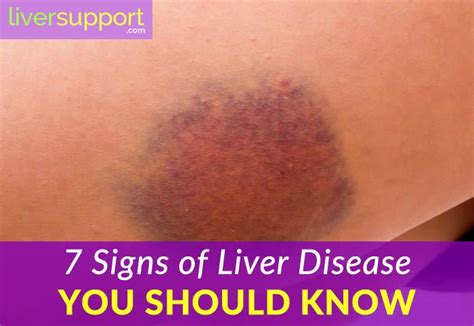 7 Symptoms Of Liver Disease You Should Know About Liver Disease