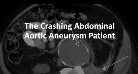 Emergency Medicine Educationthe Crashing Abdominal Aortic