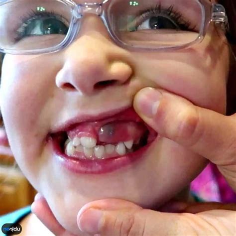 Diş Kisti Nedir Diş Kistinin Belirtileri ve Tedavisi
