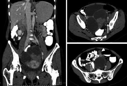 (a) coronal plane (b) sagital plane. Abdominal CT scan of this patient, A) Coronal plane of ...