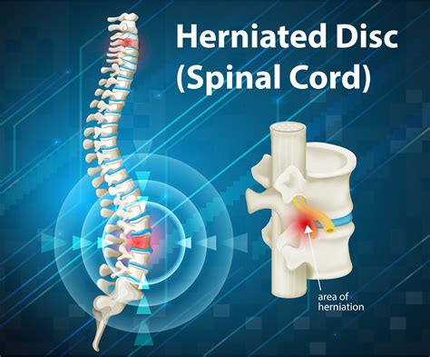 what is a herniated disc signs and symptoms