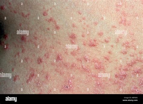 Acute Guttate Psoriasis Lesions On The Back Of A Patient Stock Photo