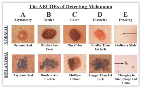 Visual Abcs Of Melanoma Guide To Differentiating Melanoma From A