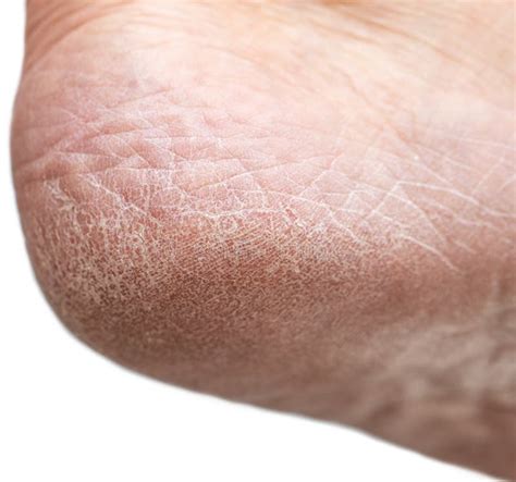 Dry Cracked Skin On The Heels Of The Feet Stock Photo Image Of Feet