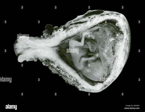 13 Week Old Human Fetus Stock Photo Alamy