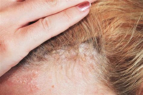 guide to scalp psoriasis know their symptoms treatments and prevention