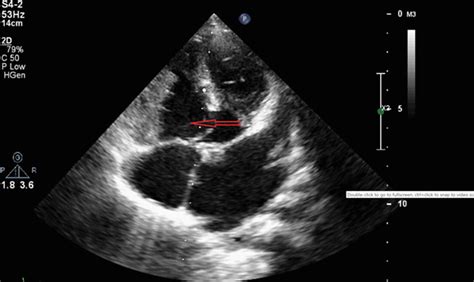 Echocardiogram Vsd