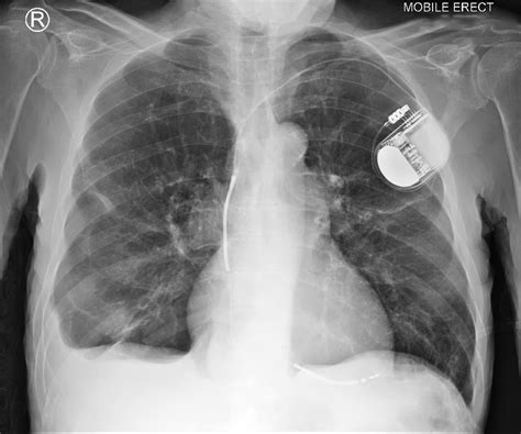 Biventricular Pacemaker Chest X Ray