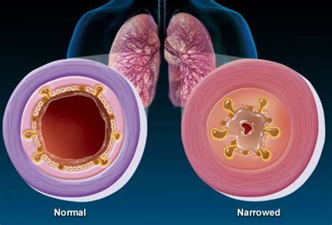 How To Tell If Bronchitis Is Turning Into Pneumonia