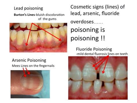 Just One Look In The Mouth And I Know Fluoride Free Australia