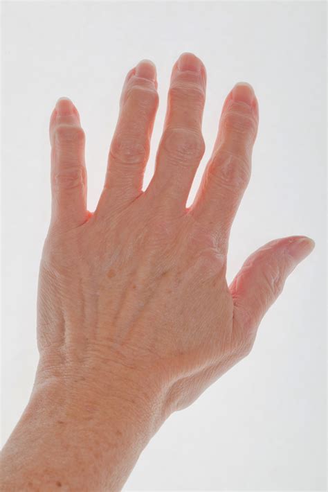 Finger Arthritis Signs Symptoms And Treatment