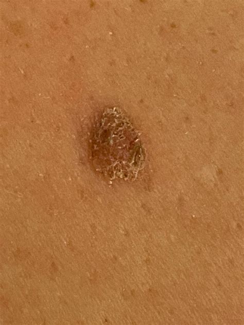 Does This Crusty Mole On My Husbands Back Look Like Cancer To You R