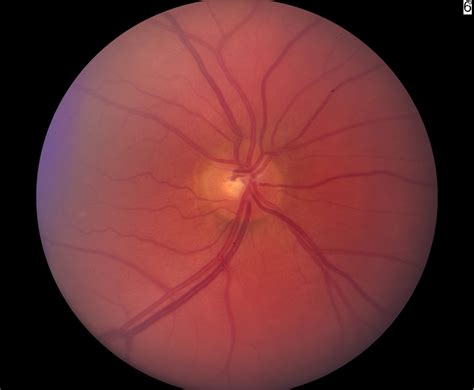 Ch 1 Glaucoma Optic Nerve Disease A Patients Guide To Glaucoma