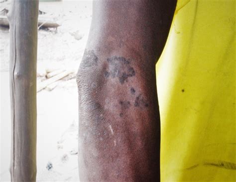 Smaller Fishes In Cartons Black Itchy Spots On Skin Awoko Newspaper