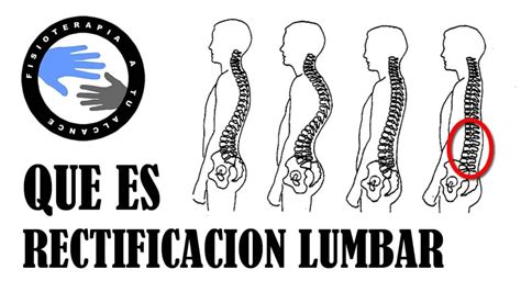 ֍ Rectificación De La Columna Cervical Y Lumbar ⚕️ Clínica Estemedic