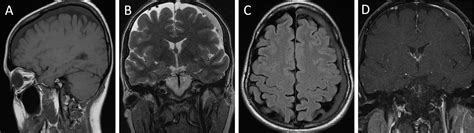 Spontaneous Chronic Subdural Haematoma Due To Hypoplastic Rostral