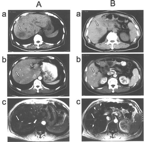 Serial Changes In Radiological Findings Of The Two Major Liver