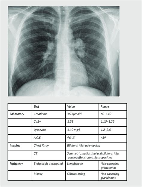 Cd103 in the lung airways and lung parenchyma 45 days after in (black bar) or im (white bar) infection. Chest X-ray showing clear lung parenchyma, no | Download Scientific Diagram