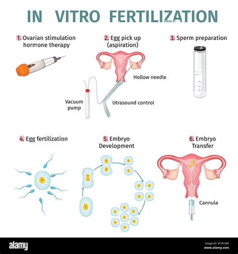 Concepto de fertilización in vitro con pasos y procedimientos de artificial ilustración del