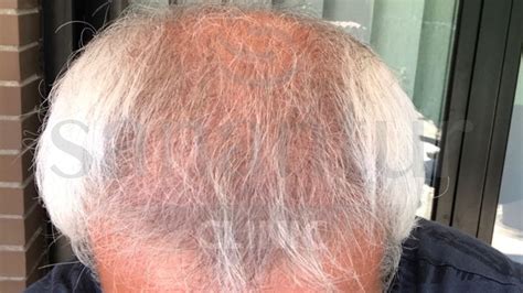 Avant et Après la greffe de cheveux - Evolution mois par mois - Sanantur