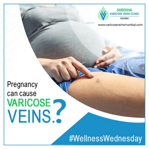 Treatment For Varicose Veins During Pregnancy Surekha Varicose Veins Clinic Laser Treatment