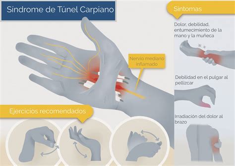 Síndrome De Túnel Carpiano Neurocirugía De La Torre