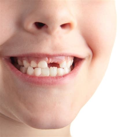 Como Fica Gengiva De Bebe Quando Vai Nascer Dente