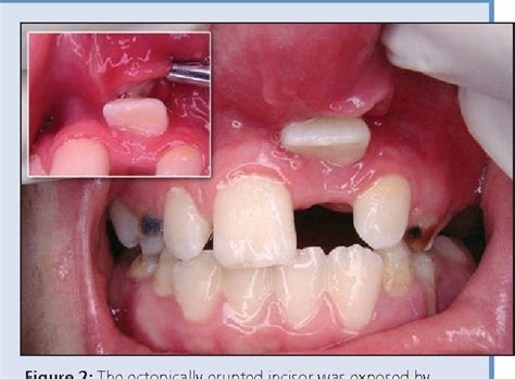 Figure 2 From Unusual Ectopic Eruption Of A Permanent Central Incisor