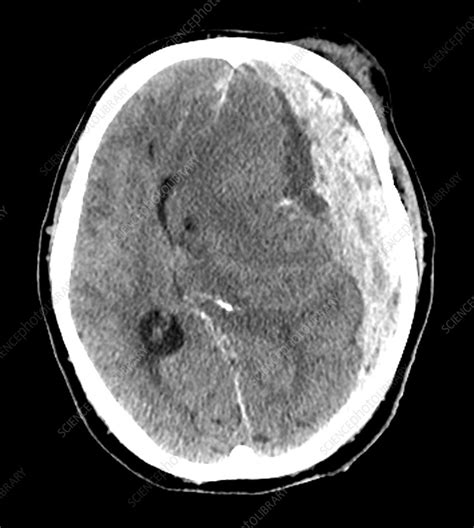 Extensive Traumatic Brain Injury Ct Stock Image C0271684 Science