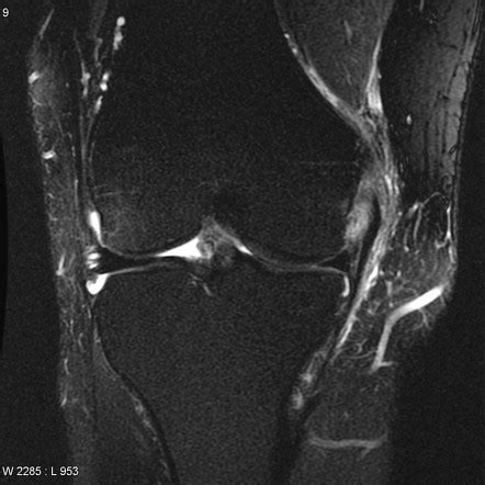 Medial Collateral Ligament Tear Grading Management Teachmesurgery Hot Sex Picture