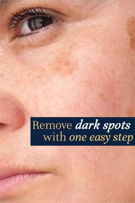 How To Fade Dark Spots Naturally Video How To Fade Dark Spots On