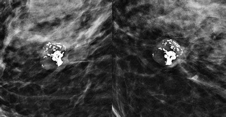 Popcorn Calcification Within The Breast Radiology Reference Article Radiopaedia Org