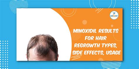 Minoxidil Results For Hair Regrowth Types Side Effects