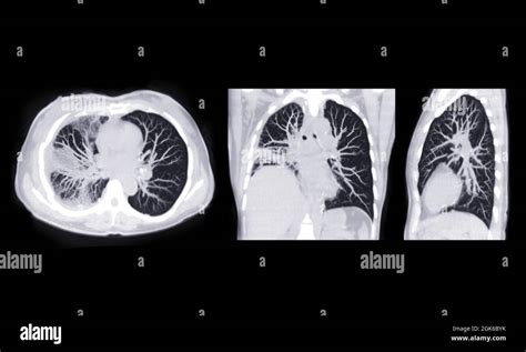 Ct Scan Of Chest Or Lung Axial Coronal And Sagittal Mip View Of Lung