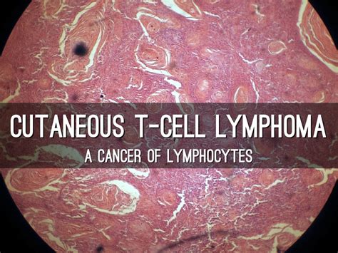 Cutaneous T Cell Lymphoma By Wes Hoffman