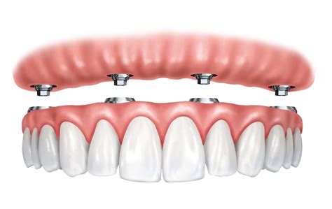 Implante dentário Allegra Odontologia