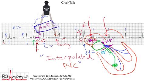 Ecg Academy Chalktalk 243 This Advanced Chalktalk Was Originally