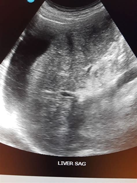 Liver Cirrhosis With Ascites Ultrasound School Ultrasound Sonography