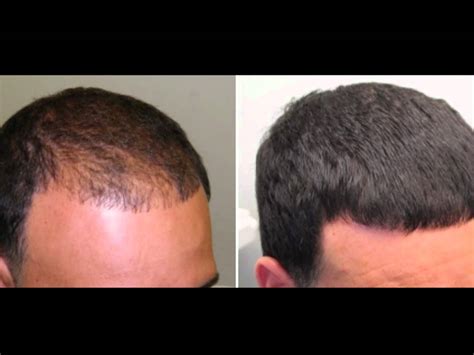 20 finasteride and minoxidil before and after results of starting with nw2 to nw5/6! Kirkland minoxidil before and after beard - BeardStylesHQ