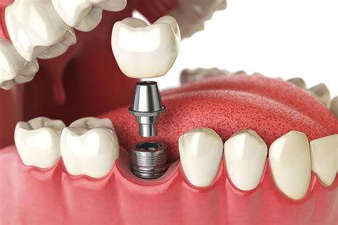 Implantes dentales para recuperar tu sonrisa Dentologies Salud Dental Inteligente Clínica