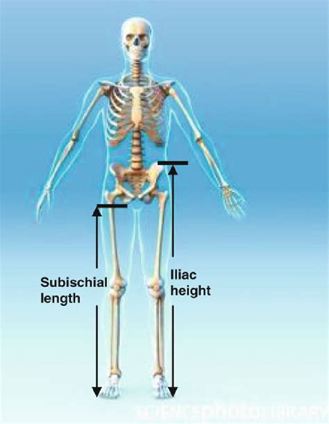 3 Landmarks For The Measurement Of Iliac Height Ih And Subischial Leg