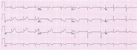 Inferior St Elevation Myocardial Infarction