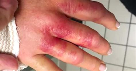 Woman Says She Almost Lost Hand To Flesh Eating Bacteria After Manicure