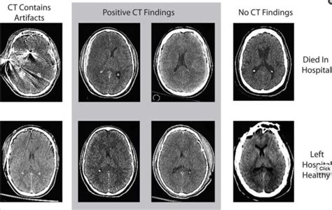 Revealing Latent Value Of Clinically Acquired Cts Of Traumatic Brain