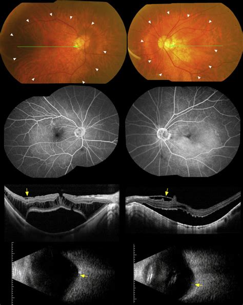 Clinical Characteristics Of Posterior Staphylomas In Myopic Eyes With