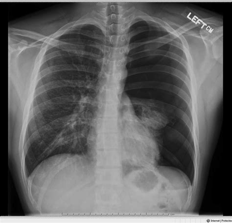 Ultrasound Findings In Tension Pneumothorax A Case Report Journal Of