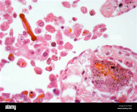 Asbestos In Lung Tissue Light Micrograph Stock Photo Alamy