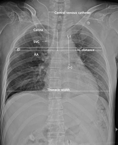 Chest Radiography For Simplified Evaluation Of Central Venous Catheter