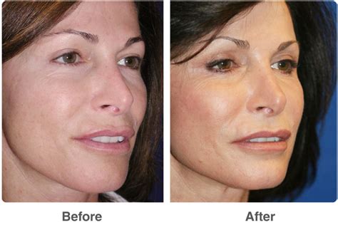 Laser Skin Resurfacing Estrella Aesthetics And Surgical Arts